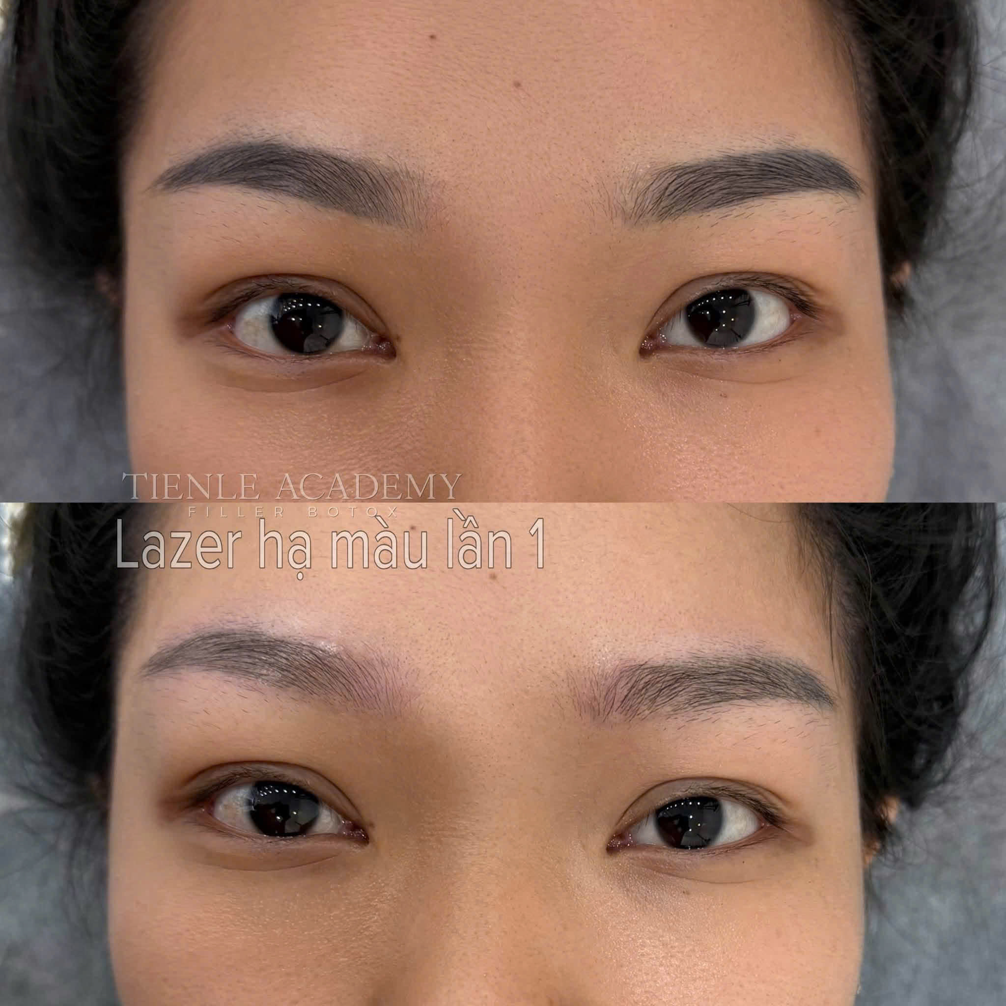 Hình ảnh trước sau xoá mày lần đầu