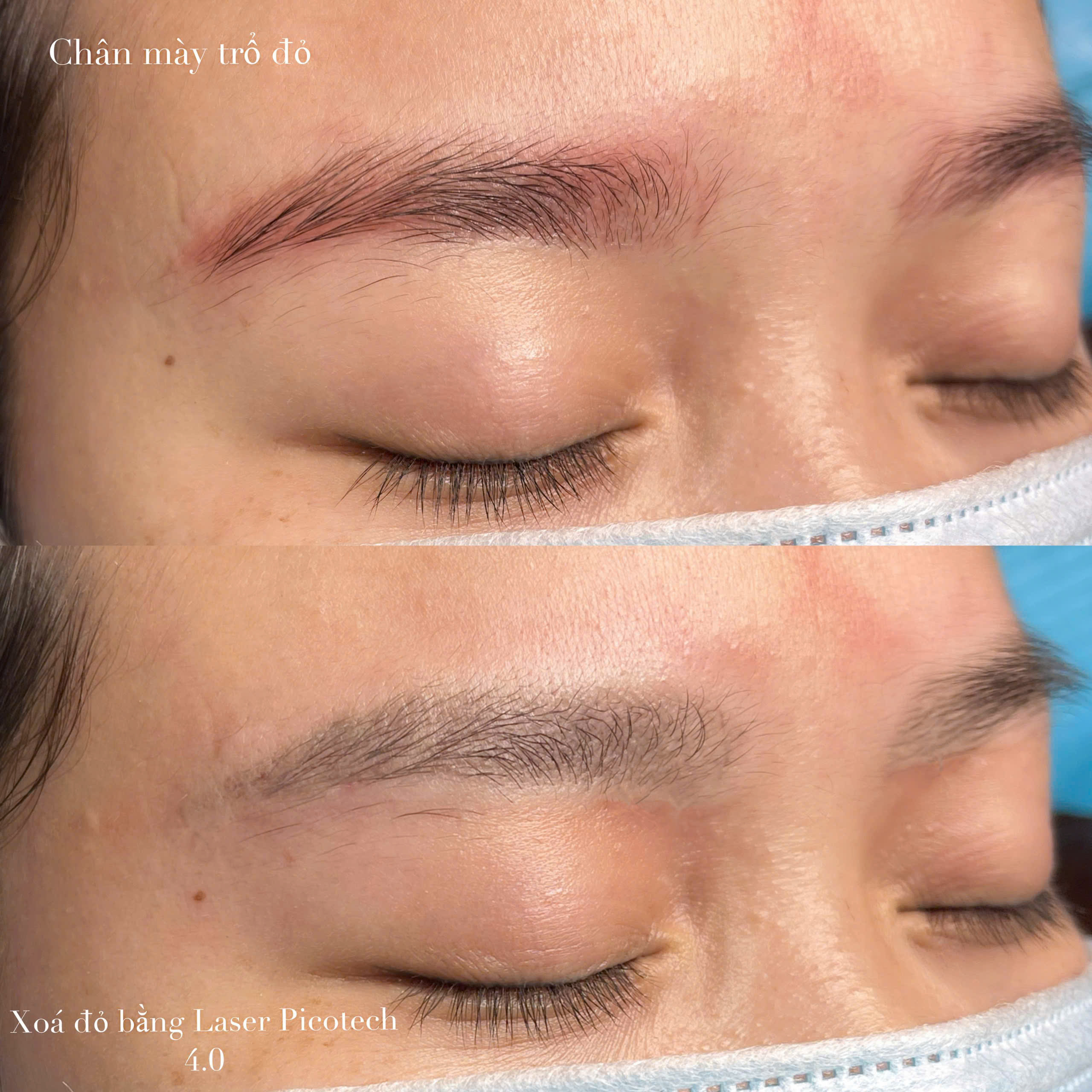 Kết quả trước sau xoá xăm chân mày trổ đỏ bằng laser tại Rạch Giá